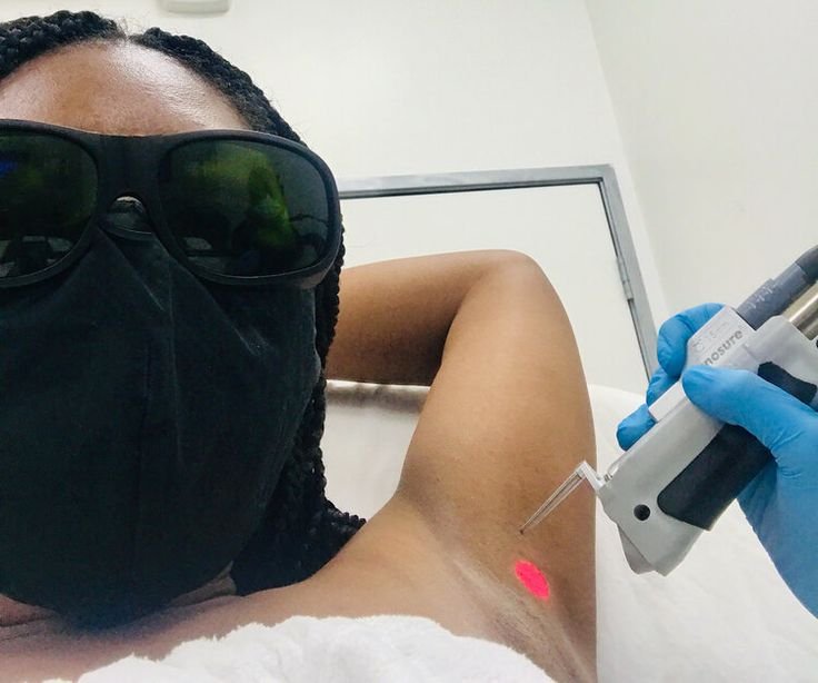 epilation